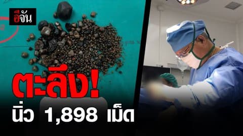ฮือฮาทั้งโรงพยาบาล! ผ่าตัดคนไข้ เจอนิ่วถุงน้ำดีอื้อ
