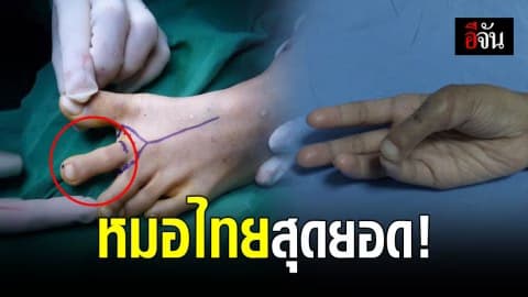 หมอไทยเก่ง ผ่าตัดเอานิ้วเท้ามาเป็นนิ้วหัวแม่มือ