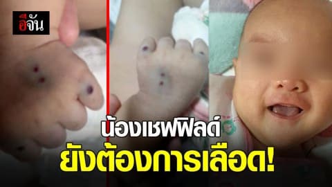 น้องเชฟฟิลด์ ป่วยเป็นโรคภูมิคุ้มกันทำลายตัวเอง ยังต้องการเลือด