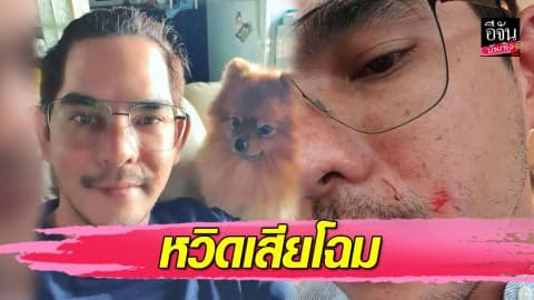 “บิ๊ก ศรุต” เกือบเสียโฉม โชว์แผลโดนสุนัขกัด ต้องฉีดยา 5 เข็ม
