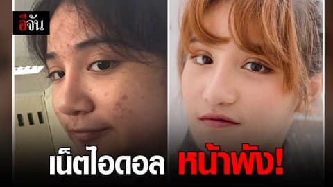 น้องครีม เน็ตไอดอล ใช้ครีมแล้วหน้าพัง ต้องรักษาตัว ที่ รพ.