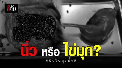 นายแพทย์โพสต์เตือน นิ่วในถุงน้ำดี