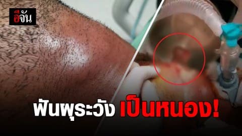 ปวดฟัน จนคางบวม-เป็นหนอง-ติดเชื้อ ต้องผ่าตัดเจาะคอ