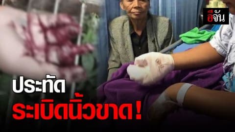 อุทาหรณ์ เด็กชายวัย 13 ปี จุดประทัดเล่น ระเบิดใส่มือ นิ้วขาด 3 นิ้ว
