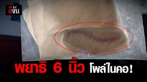 หนุ่มโพสต์สยอง พบพยาธิไส้เดือนยาว 6 นิ้ว ในลำคอ