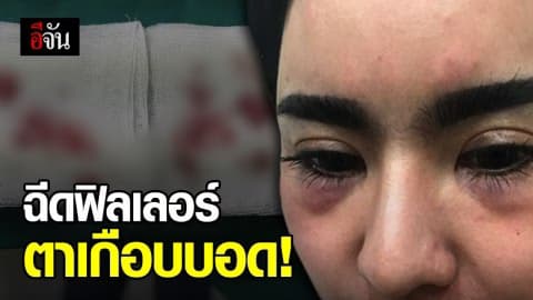 อุทาหรณ์ฉีดฟิลเลอร์ เกือบเสียตาทั้ง 2 ข้าง