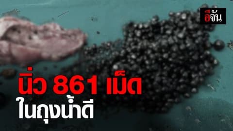 แพทย์เตือนนิ่วในถุงน้ำดี อายุน้อยก็เป็นได้