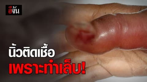 อุทาหรณ์! ความสวยงาม นิ้วติดเชื้อเพราะทำเล็บ
