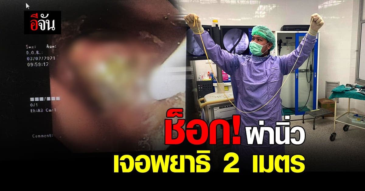 ช็อกทั้งหมอ ทั้งคนไข้ ผ่าตัดนิ่ว แต่เจอพยาธิ 2 เมตร