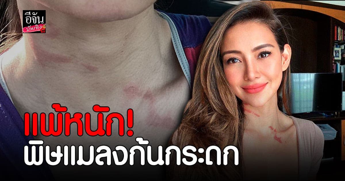 โย ยศวดี เตือนภัย โดนพิษ แมลงก้นกระดก แพ้หนัก อาเจียน 3 รอบ