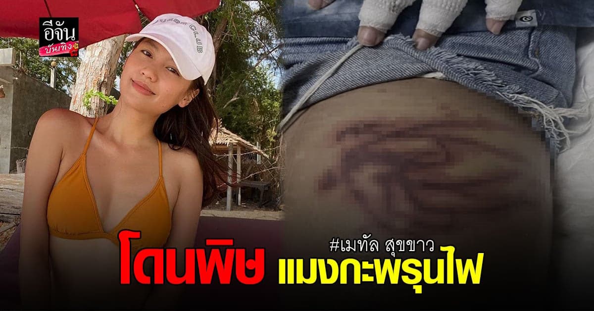 เมทัล เผยภาพบาดแผล หลังโดนพิษร้ายของ แมงกะพรุนไฟ เล่นงาน