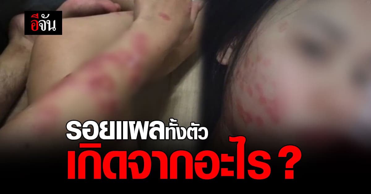 รอยแดงเต็มหน้า เต็มตัว คาดเพราะเชื้อราแมว ?