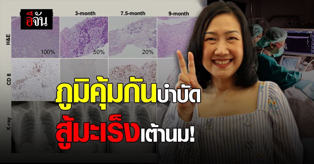 ชีวิตใหม่! คนแรกของโลก ภูมิคุ้มกันบำบัด รักษามะเร็งเต้านม ได้สำเร็จ