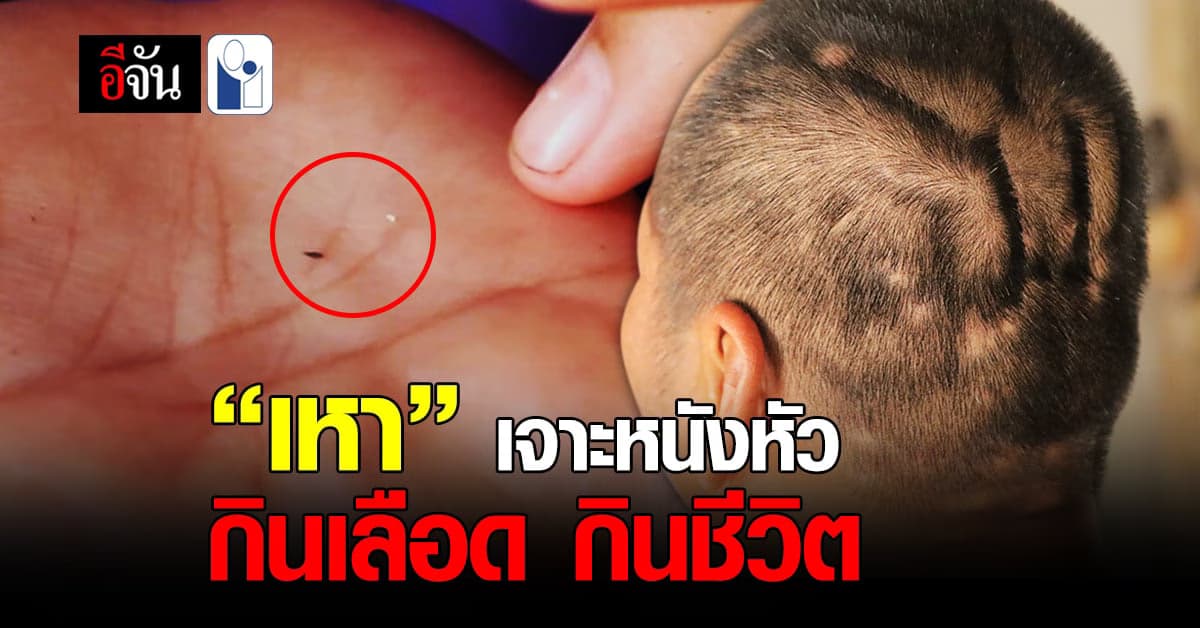 ปวดทรมาน “เหา” เจาะฝังไข่ในหัว