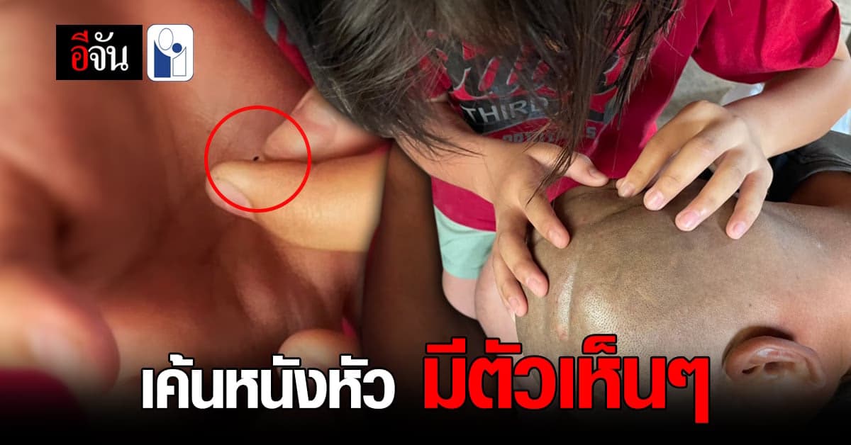 เหา ดูเลือด กลืนชีวิต มีตัวเห็นๆ