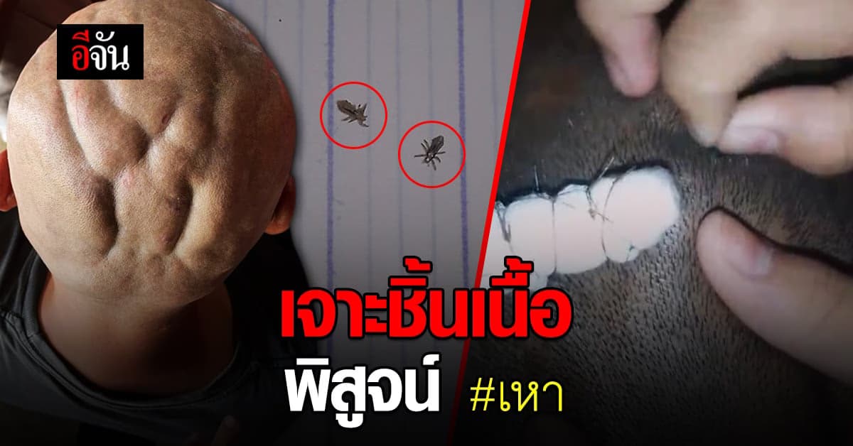 เจาะชิ้นเนื้อพิสูจน์ #เหา ฟักไข่ในหนังหัว