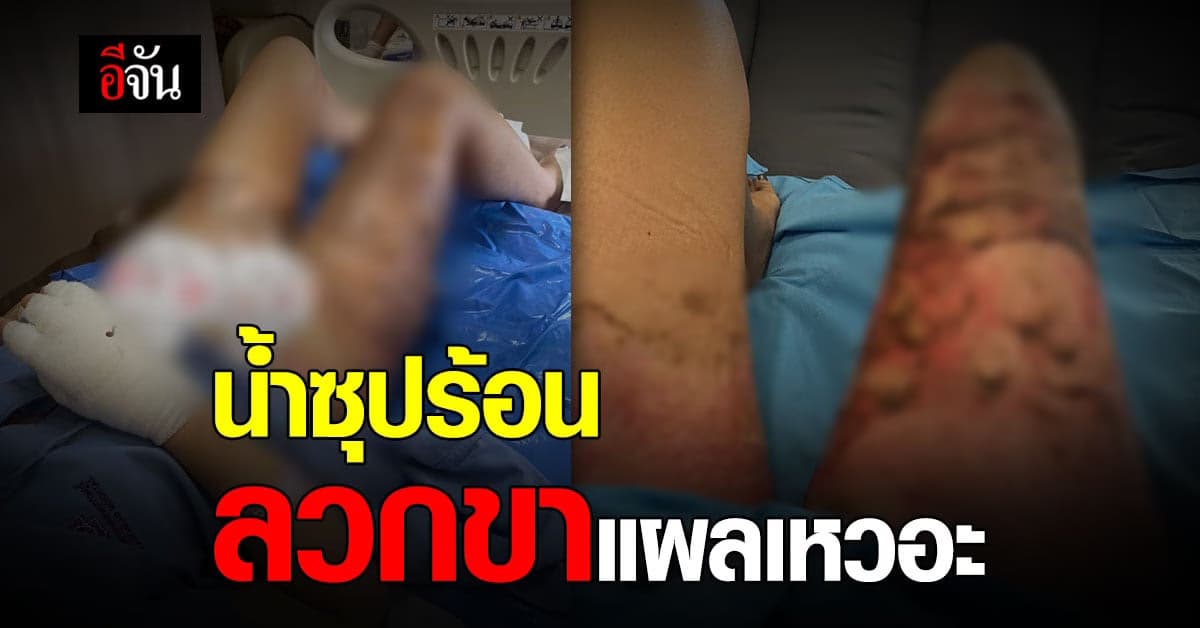 สาวถูกคนชนโต๊ะ น้ำซุปใน หม้อจิ้มจุ่ม ลวกขากลายเป็น แผลพุพอง – คู่กรณีไม่รับผิดชอบ?
