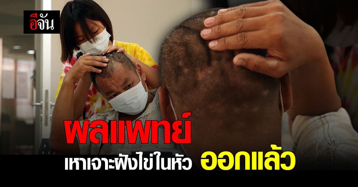 ผลตรวจชิ้นเนื้อหาเหาในหัว ออกแล้ว! มันคือเหา หรืออะไรกันแน่ ?