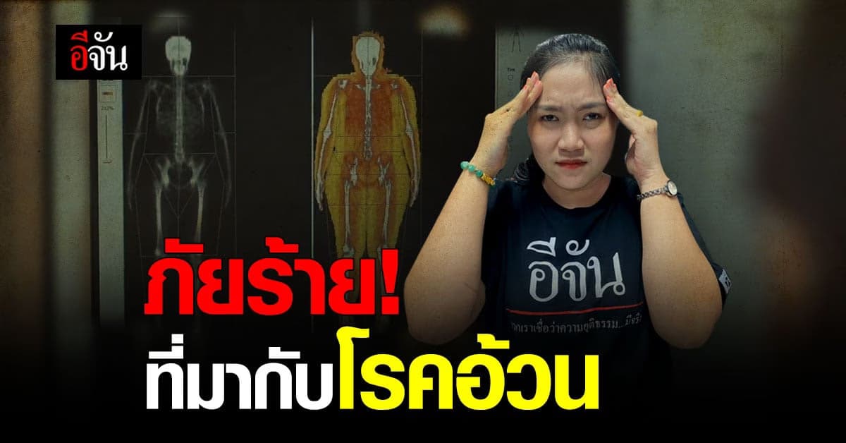 เช็กเลย เรากำลังเป็น โรคอ้วน หรือเปล่านะ