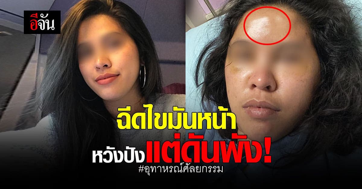 สาวฝากเป็นอุทาหรณ์ ฉีดไขมันหน้า หวังปังกลับพัง หน้าผากเป็นก้อน!