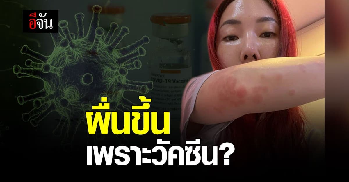 สาวนักบิน โพสต์รีวิว ผื่นขึ้นตัว หลัง ฉีดวัคซีนซิโนแวค คาด เป็นผลข้างเคียง