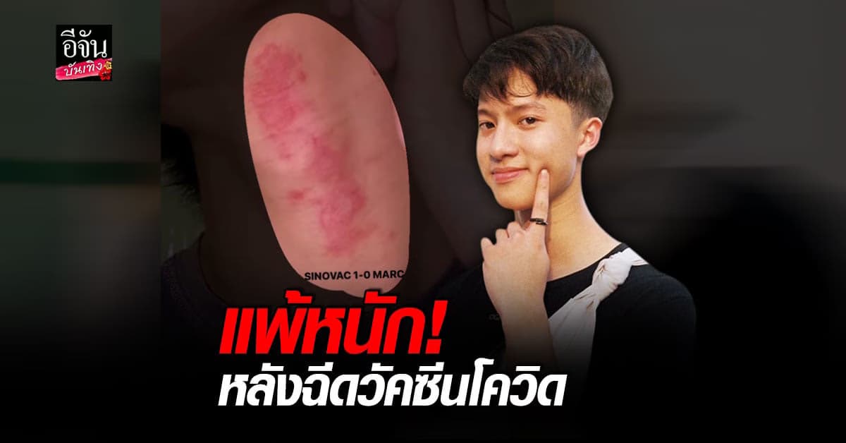 มาร์ค ธนัท แชร์ประสบการณ์หลังฉีดวัคซีน Sinovac มีอาการแพ้คอแดง