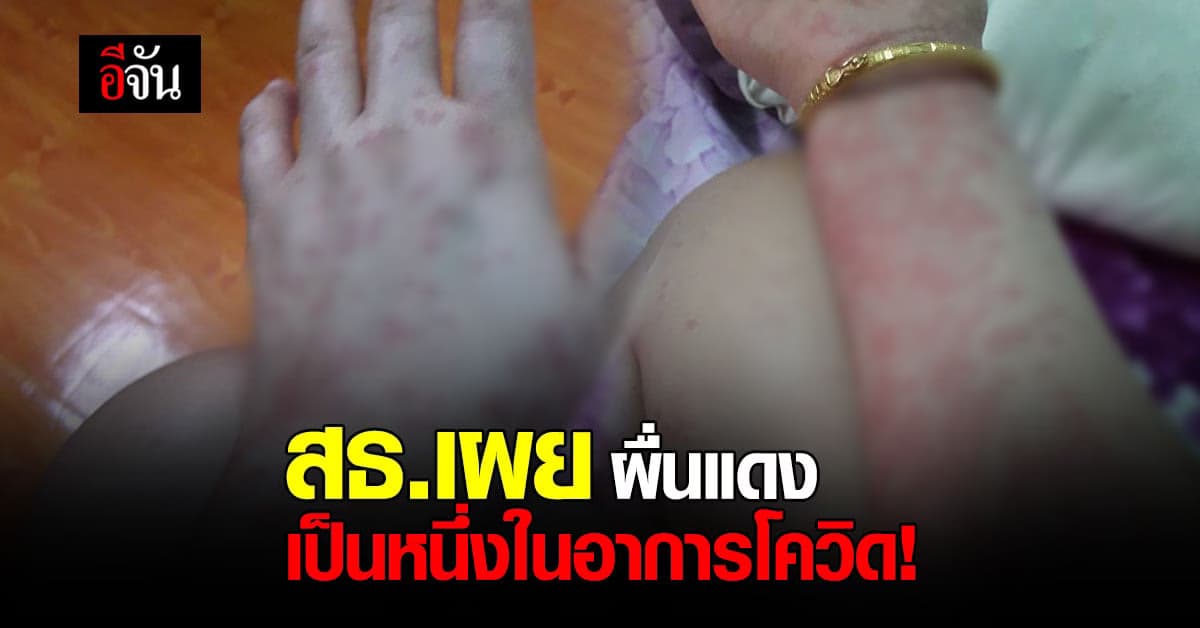 ชัดแล้ว! ผื่นแดงเต็มตัวสาวป่วยโควิด สธ.ตอบแล้ว เป็นหนึ่งในอาการโควิด