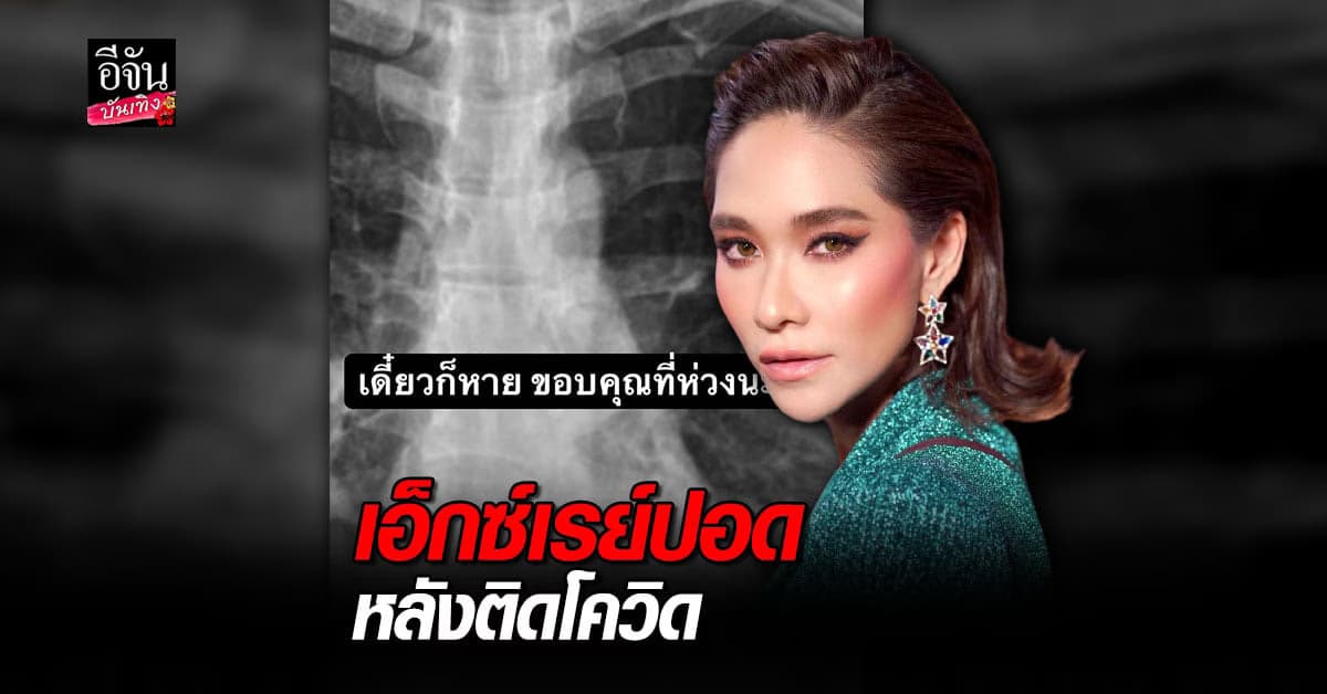 พลอย เฌอมาลย์ เผยภาพเอ็กซ์เรย์ปอด พร้อมขอบคุณทุกคนที่ห่วงใย