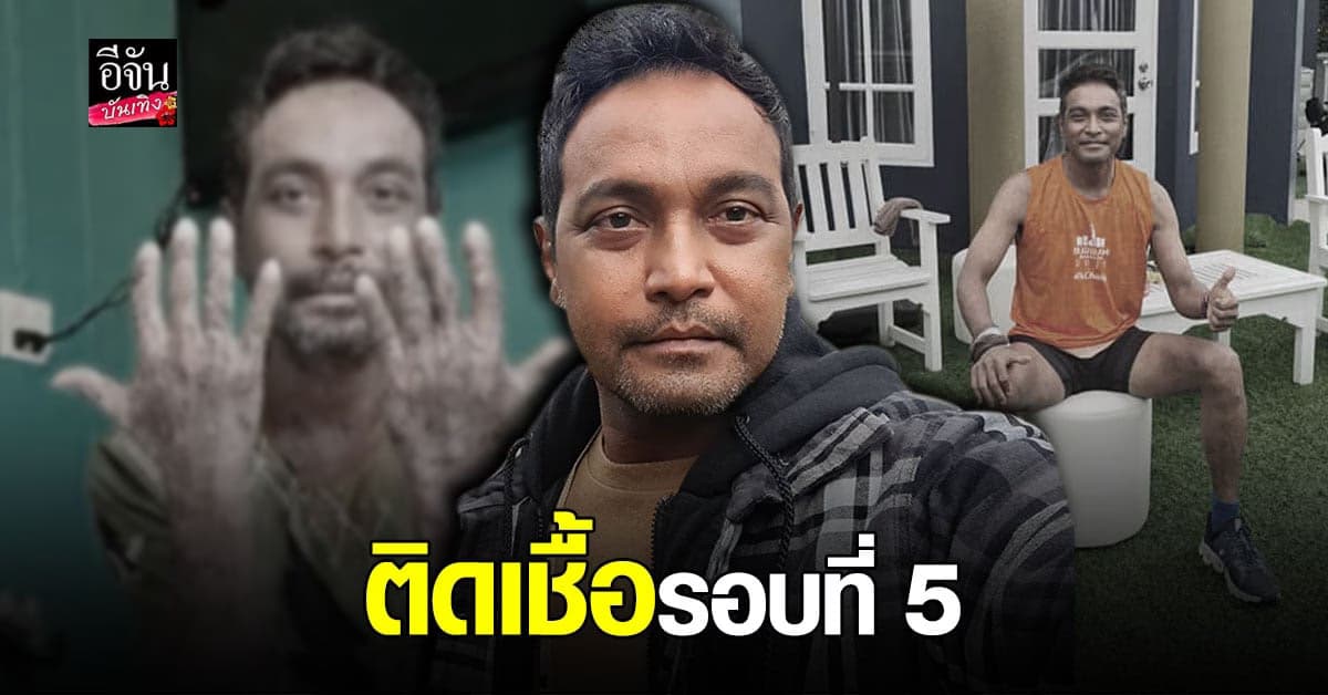 เมฆ วินัย เผย ตุ่มน้ำพอง กำเริบอีก สุด ทรมาน โอด เน่ามาก คงถ่ายละครไม่ได้