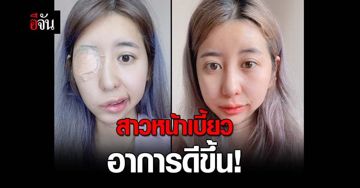 น้ำมนต์ สาวหน้าเบี้ยว อาการดีขึ้น ลุ้นหายปกติเร็วๆนี้