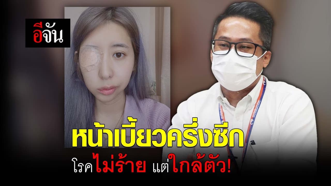 (Video) หน้าเบี้ยวครึ่งซีกโรคไม่ร้าย แต่ใกล้ตัว!
