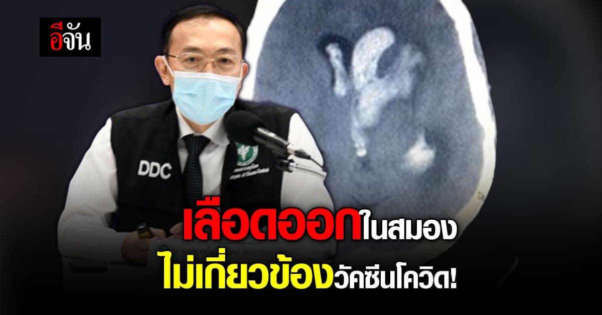 กรมควบคุมโรค ตอบชัด สาววัย 29 เลือดออกในสมอง ไม่เกี่ยวข้องวัคซีนโควิด