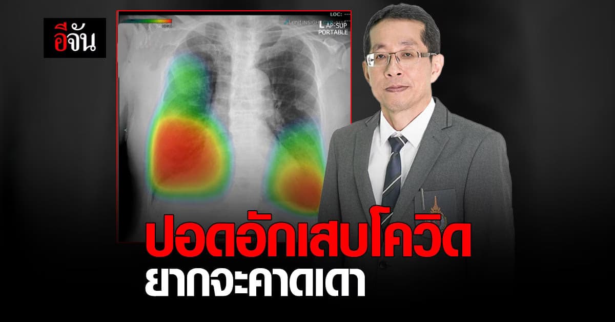 หมอนิธิพัฒน์ เผย อาการปอดอักเสบจากโควิด ยากจะคาดเดา