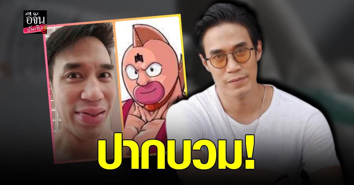 ดอม เหตระกูล เผย ผลข้างเคียง หลัง ฉีดวัคซีน  เข็มแรก ปากบวม