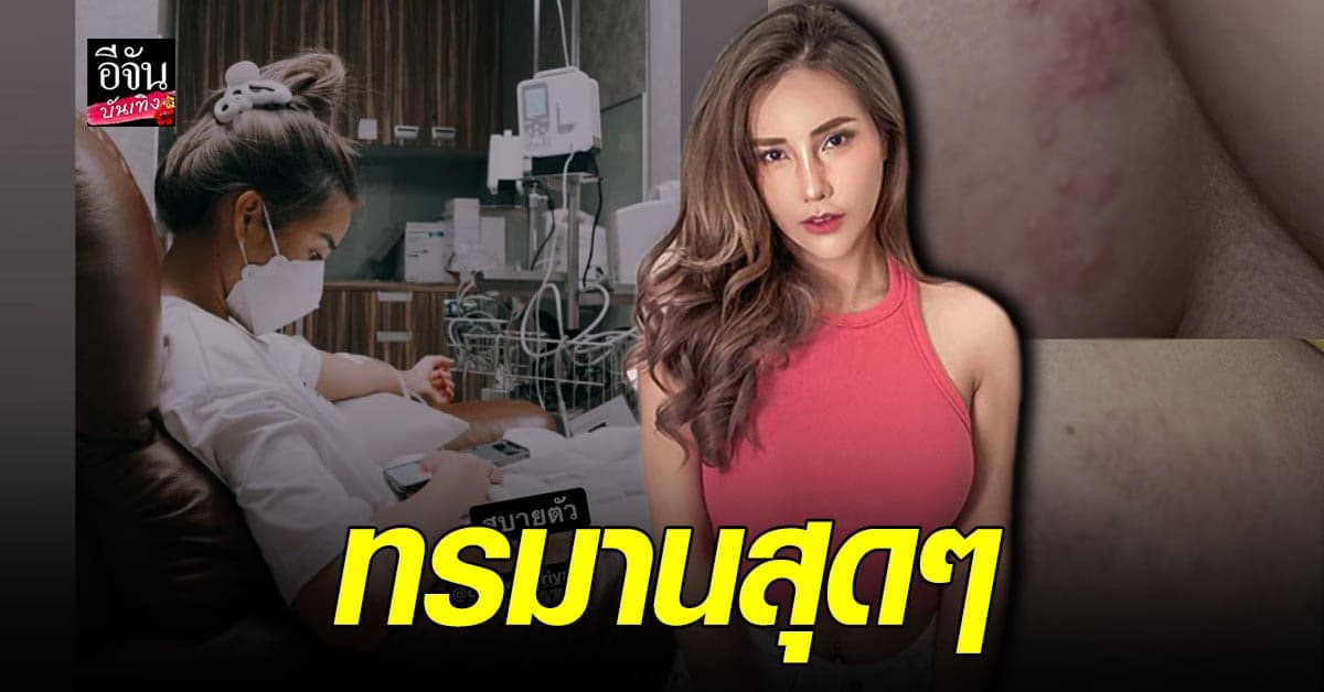 ชีสเค้ก จริยา เป็นงูสวัด ปวดแสบปวดร้อนจนนอนไม่หลับ