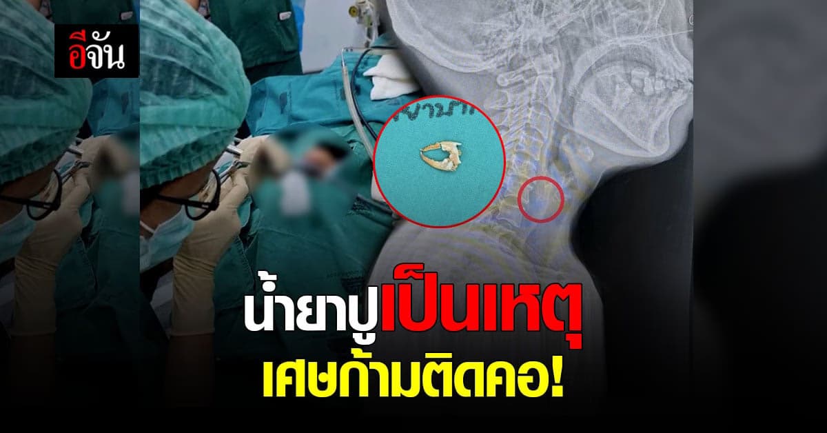 ขนมจีนน้ำยาปูเป็นเหตุ เศษก้ามติดคอ เข้าห้องผ่าตัดด่วน