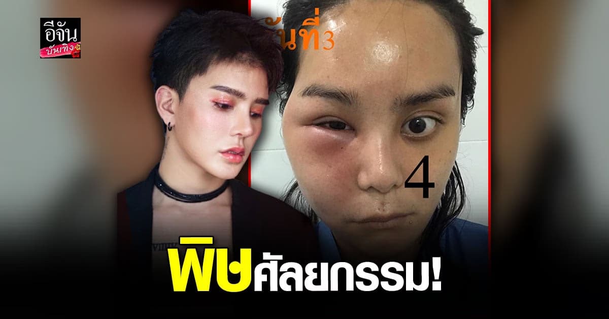 อาร์ม ตรีทิพย์นิภา เผยภาพหน้าเก่า บวม เน่า เพราะพิษศัลยกรรม!