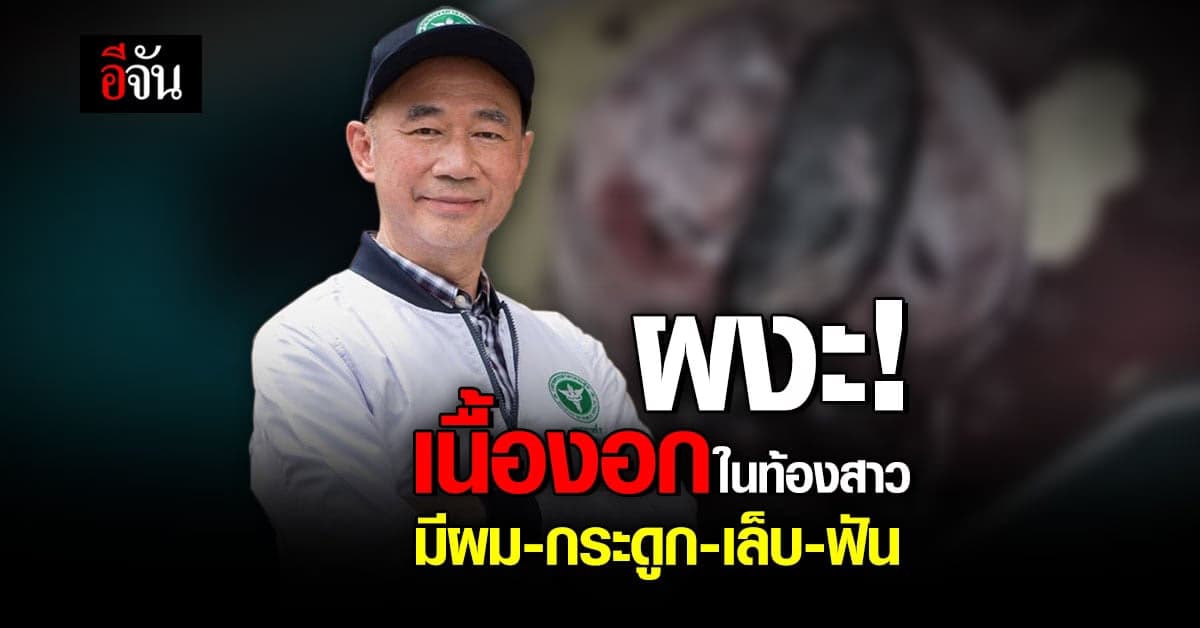 หมอยังตะลึง ผ่าตัดเนื้องอกในท้องสาว 17 เจอผมกระดูกเล็บฟัน