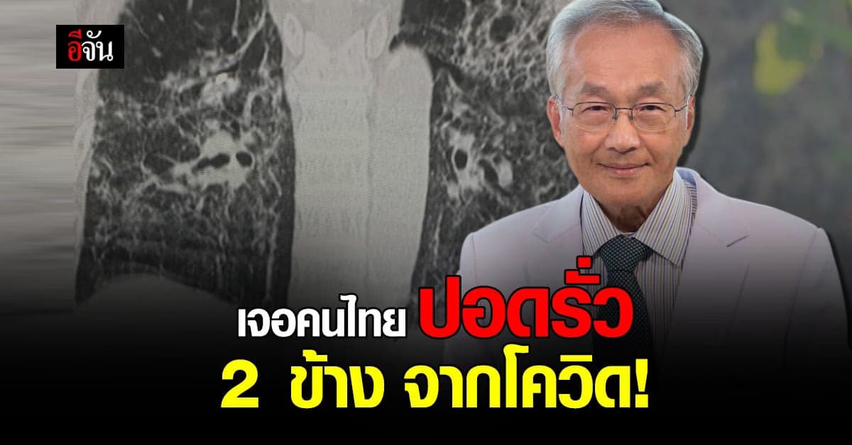 หมอมนูญ เผย เจอคนไข้สูงอายุ ปอดรั่ว จากการป่วยโควิด