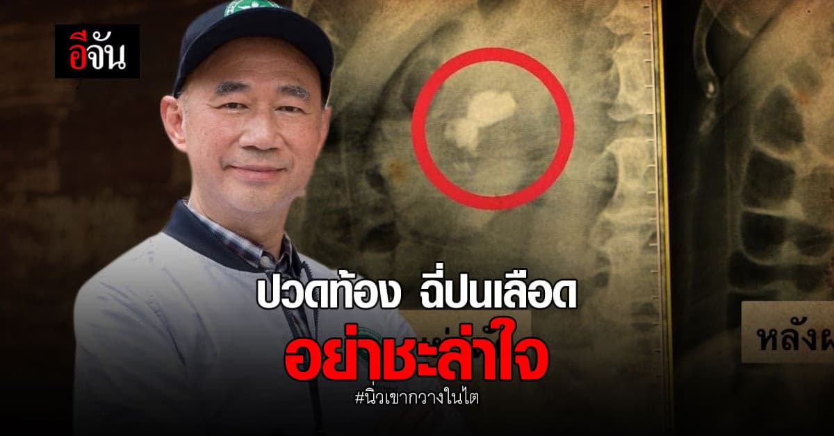 สาวกลางคน ฉี่ปนเลือด ปวดท้อง ผงะ! เจอนิ่วเขากวางในไต ขนาดใหญ่