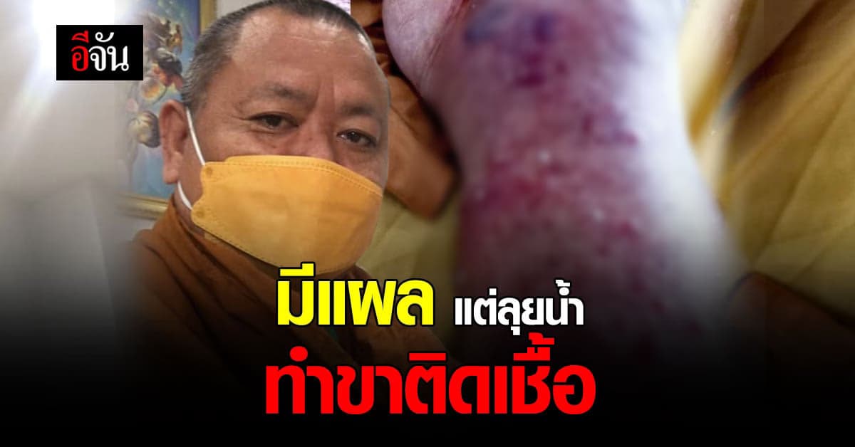 ภัยเงียบไม่รู้ตัว แผลเล็กนิดเดียว ลุยน้ำครั้งเดียว เกือบได้ผ่าตัด
