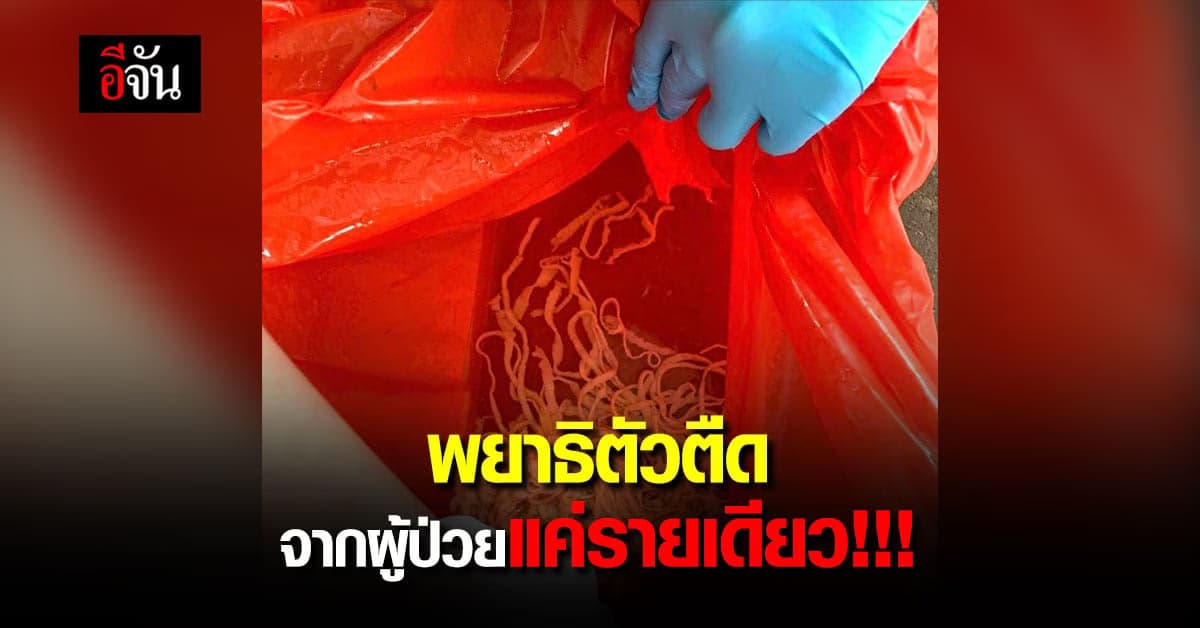 ศูนย์วิจัยโรคปรสิต เผยภาพ พยาธิตัวตืดอื้อ จากผู้ป่วยแค่รายเดียว