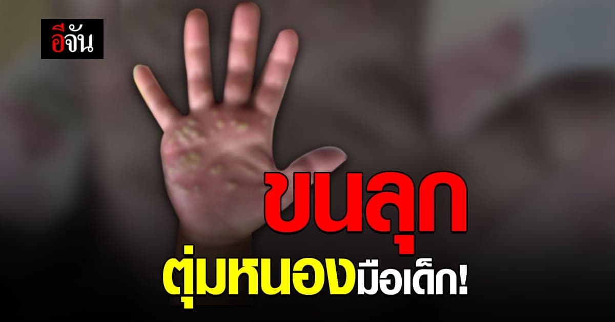 ตุ่มหนอง ขึ้นมือเด็ก ภัยเงียบใกล้ตัว ที่พ่อแม่ควรรู้!