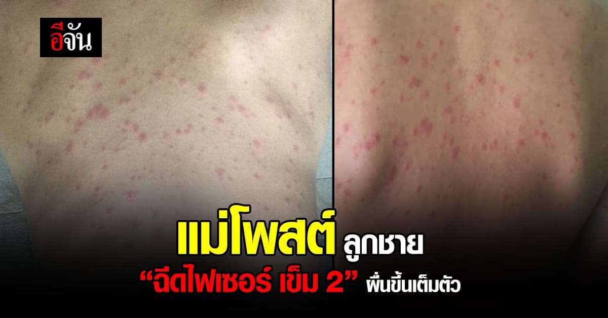 แม่โพสต์ ลูกชาย ฉีดวัคซีน ไฟเซอร์ เข็ม 2 ผื่นขึ้น เต็มตัว