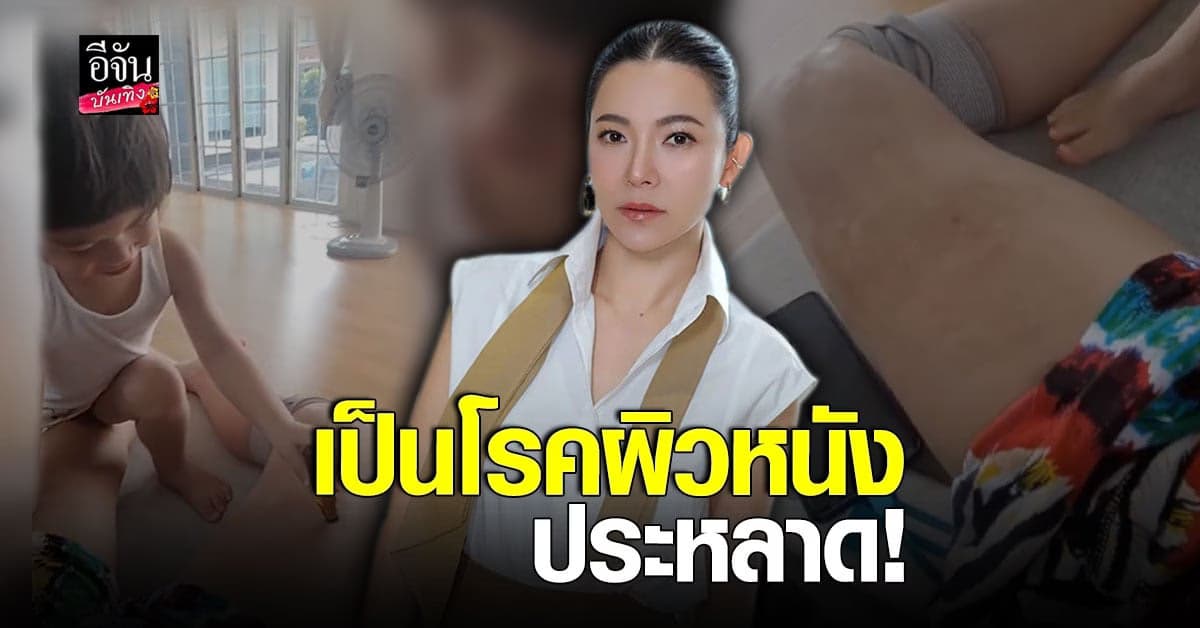 ต้นหอม ศกุนตลา เป็น โรคผิวหนัง ประหลาด วอนใครรู้วิธี รักษา ช่วยบอกที