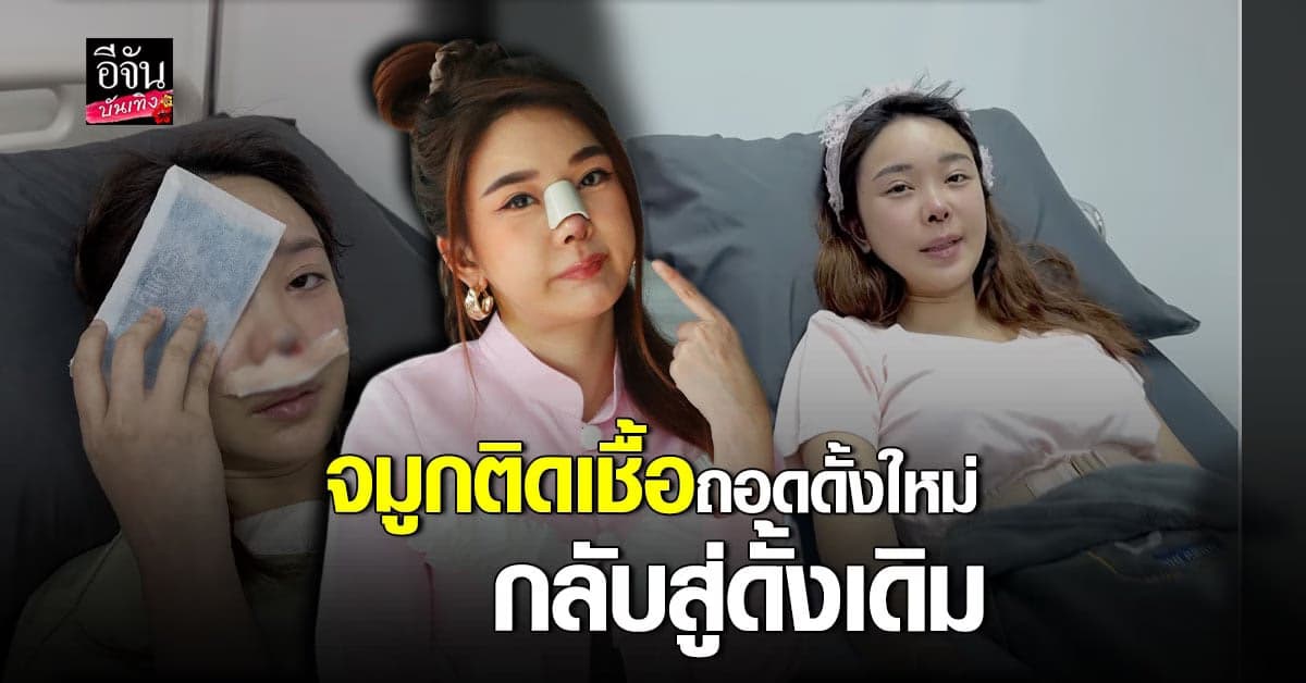 หญิงแย้ จมูกติดเชื้อ ต้องถอด ซี่โครงเทียม ออก พักยาว 6 เดือน