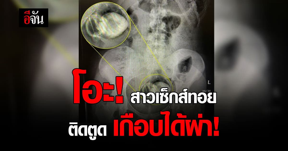 แม่เจ้า สาวสวยลอนดอน วิ่งเข้าห้องฉุกเฉิน เซ็กส์ทอย ติดตูด