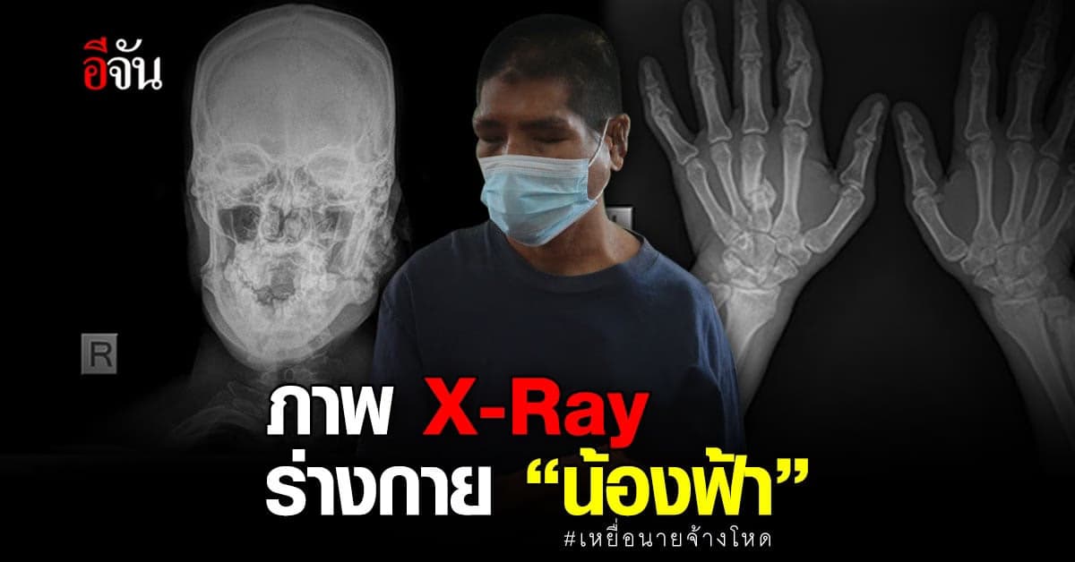 เปิดภาพ X-Ray ร่างกาย น้องฟ้า กระดูกผิดรูป แตก หัก ทั้งตัว!