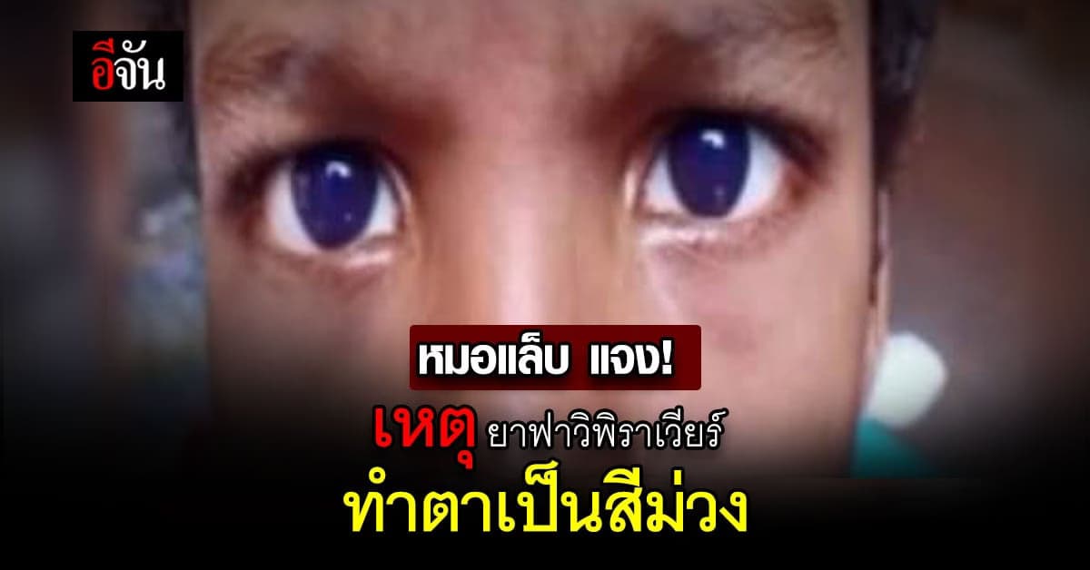 หมอแล็บ แจง สาเหตุ ตาเป็นสีม่วงหลัง กินยา ฟาวิพิราเวียร์