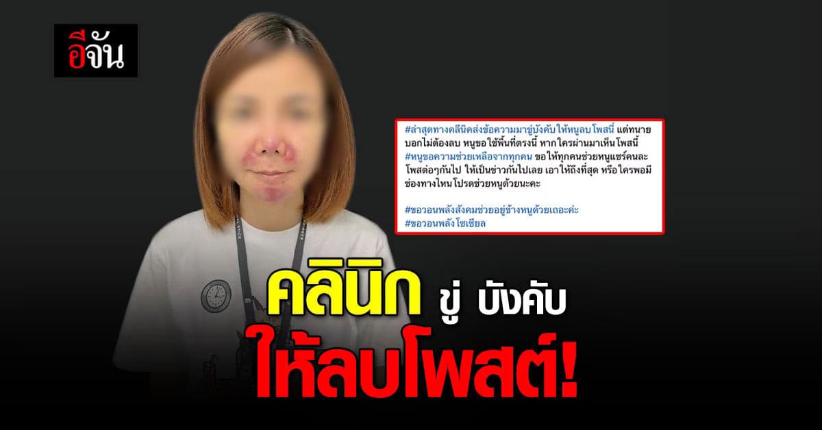 สาวโพสต์ หน้าพังเพราะฟิลเลอร์ เผย คลินิกขู่ให้ลบ